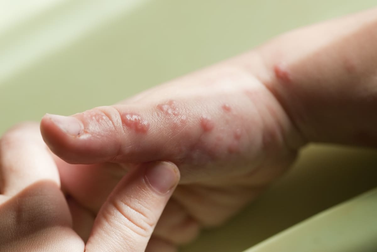 你是帶狀疱疹高風險族群嗎 ?